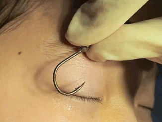 Bé trai 7 tuổi bị móc câu đâm vào mắt: Lời cảnh tỉnh về tai nạn mùa Hè