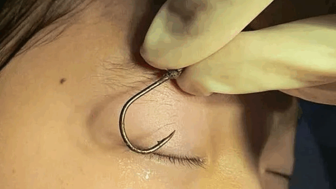 Bé trai 7 tuổi bị móc câu đâm vào mắt: Lời cảnh tỉnh về tai nạn mùa Hè Bé trai 7 tuổi bị móc câu đâm vào mắt: Lời cảnh tỉnh về tai nạn mùa Hè