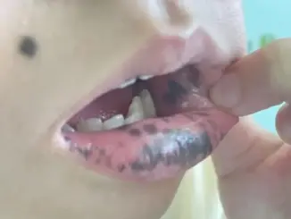 Mẹ phát hiện môi con gái 10 t:u:ổ:i có nhiều đốm đen kỳ lạ, đến bệnh viện kiểm tra thì k:i:nh h:ã:i nghe bác sĩ nói