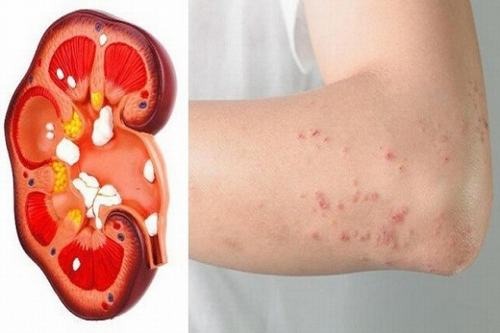9 triệu chứng khi mắc bệnh thận, suy thận ai cũng cần biết 9 triệu chứng khi mắc bệnh thận, suy thận ai cũng cần biết