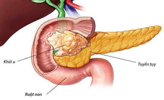 Ung thư lúc đầu không đau nhưng thấy 8 dấu hiệu khi đi vệ sinh thì nên đi khám sớm: Đừng chủ quan Ung thư lúc đầu không đau nhưng thấy 8 dấu hiệu khi đi vệ sinh thì nên đi khám sớm: Đừng chủ quan