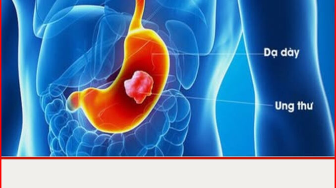 7 dấu hiệu ung thư dạ dày giai đoạn sớm, ai cũng cần biết kẻo di căn xa 7 dấu hiệu ung thư dạ dày giai đoạn sớm, ai cũng cần biết kẻo di căn xa