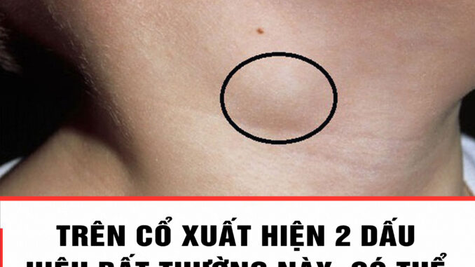 Trên cổ xuất hiện 2 dấu hiệu bất thường này, có thể tế K trong cơ thể đã thức tỉnh: Ai cũng cần biết