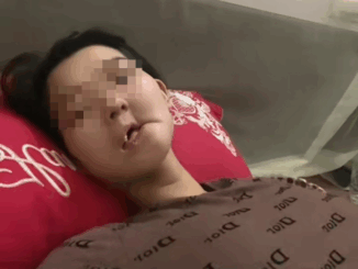 Hình ảnh cô gái mắc UT xương hàm, bữa ăn hàng ngày là “cháo xay loãng ăn bằng xi lanh” gây xót xa: Dấu hiệu phát hiện bệnh sớm trước khi quá muộn