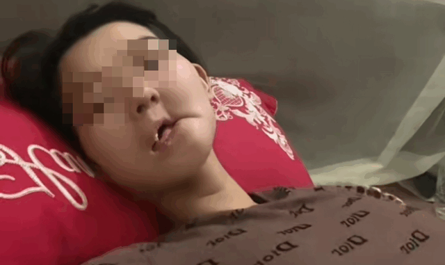 Hình ảnh cô gái mắc UT xương hàm, bữa ăn hàng ngày là “cháo xay loãng ăn bằng xi lanh” gây xót xa: Dấu hiệu phát hiện bệnh sớm trước khi quá muộn