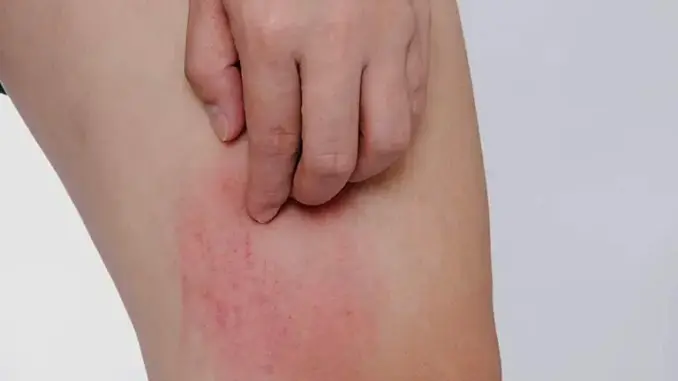 Hai bộ phận trên cơ thể ngứa ngáy là dấu hiệu của bệnh ung thư gan, nhiều người lại lầm tưởng là dị ứng Hai bộ phận trên cơ thể ngứa ngáy là dấu hiệu của bệnh ung thư gan, nhiều người lại lầm tưởng là dị ứng