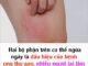 Hai bộ phận trên cơ thể ngứa ngáy là dấu hiệu của bệnh ung thư gan, nhiều người lại lầm tưởng là dị ứng