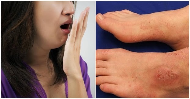 8 biểu hiện của suy thận nếu bỏ qua có thể phải chạy thận cả đời: Hôi miệng dù đã đánh răng sạch sẽ 8 biểu hiện của suy thận nếu bỏ qua có thể phải chạy thận cả đời: Hôi miệng dù đã đánh răng sạch sẽ