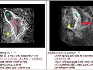 Khối u biến mất sau 4 tháng kiên trì làm 1 việc: Bác sĩ cũng phải ‘vỡ òa’