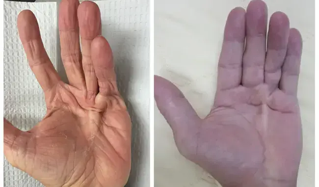 Trước khi UT đến, tay chân thường có 4 dấu hiệu này Trước khi UT đến, tay chân thường có 4 dấu hiệu này