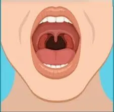Thực phẩm có thể gây UT vòm họng 'nhanh khủng khiếp', thèm đến mấy cũng nên hạn chế ăn Thực phẩm có thể gây UT vòm họng 'nhanh khủng khiếp', thèm đến mấy cũng nên hạn chế ăn