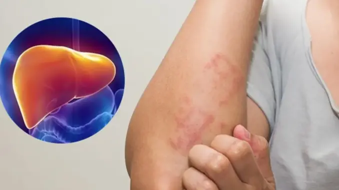 Cẩn thận: Ngứa 2 chỗ này trên cơ thể là biểu hiện của bệnh gan, đừng nhầm với dị ứng Cẩn thận: Ngứa 2 chỗ này trên cơ thể là biểu hiện của bệnh gan, đừng nhầm với dị ứng