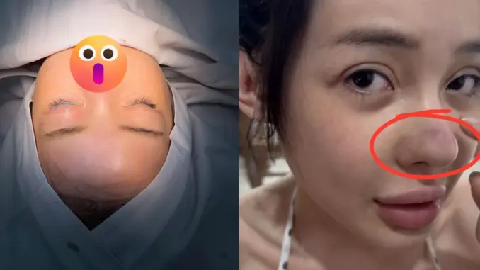 Ngân 98 lộ nốt sưng đỏ ở mũi, hủy gấp 2 show tại Campuchia, bác sĩ chẩn đoán sốc Ngân 98 lộ nốt sưng đỏ ở mũi, hủy gấp 2 show tại Campuchia, bác sĩ chẩn đoán sốc