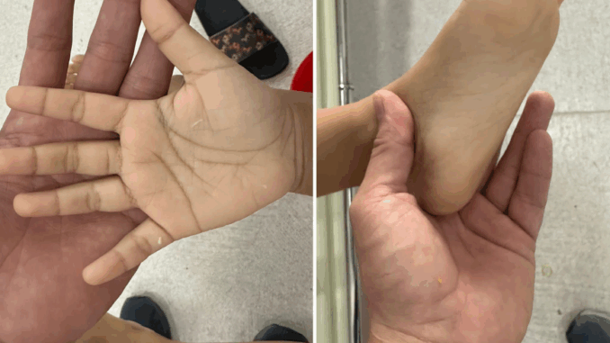 Bé gái 2 tuổi thiếu máu trầm trọng vì uống quá nhiều sữa tươi mỗi ngày Bé gái 2 tuổi thiếu máu trầm trọng vì uống quá nhiều sữa tươi mỗi ngày