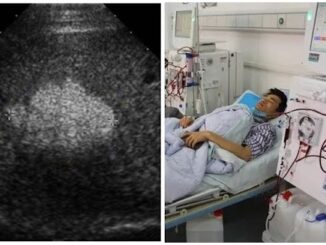 Thanh niên 26t ung thư gan dù không rượu bia, BS nói 2 thói quen ăn uống còn độc hại hơn: Ai có bỏ ngay