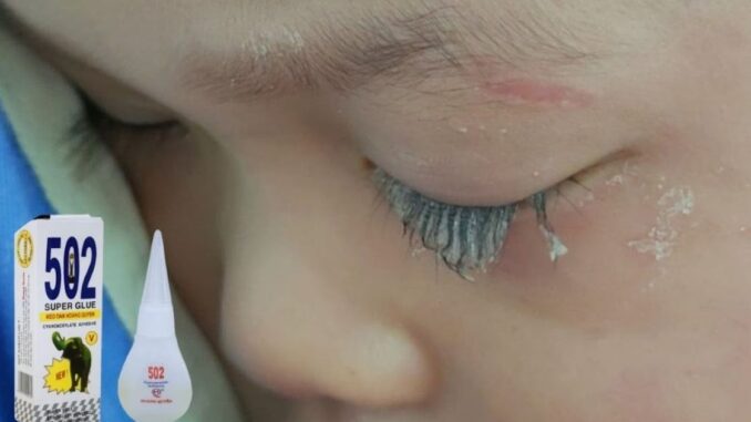 Bé trai 3 tuổi bị keo 502 bắn vào mắt, hành động của người mẹ trong “30 giây vàng” đã cứu con khỏi cảnh mù loà!