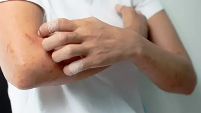 Cẩn trọng khi ngứa ở 2 bộ phận này, có thể là UT gan chứ không phải dị ứng