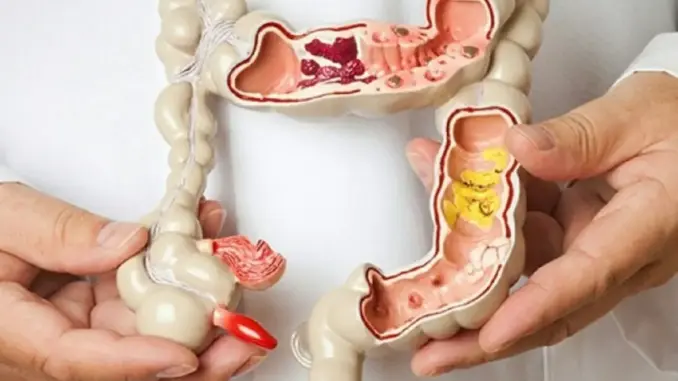 Nếu có polyp trong ruộtt, khi đi vệ sinh sẽ có 4 dấu hiệu này, đi khám ngay kẻo muộn Nếu có polyp trong ruộtt, khi đi vệ sinh sẽ có 4 dấu hiệu này, đi khám ngay kẻo muộn