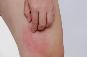 Hai bộ phận trên cơ thể ngứa ngáy là dấu hiệu của bệnh ung thư gan, nhiều người lại lầm tưởng là dị ứng Hai bộ phận trên cơ thể ngứa ngáy là dấu hiệu của bệnh ung thư gan, nhiều người lại lầm tưởng là dị ứng