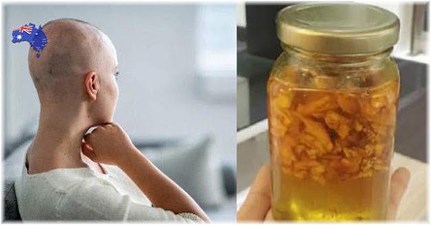 BS trả về, cô gái ở nhà kiên trì dùng gừng pha mật ong, đi khám lại thì tế bào ung thư đã mất
