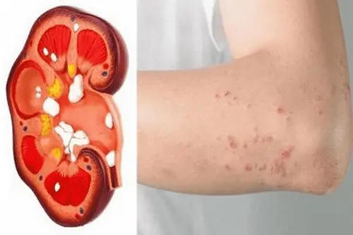 8 dấu hiệu suy thận giai đoạn đầu bạn không nên bỏ qua 8 dấu hiệu suy thận giai đoạn đầu bạn không nên bỏ qua