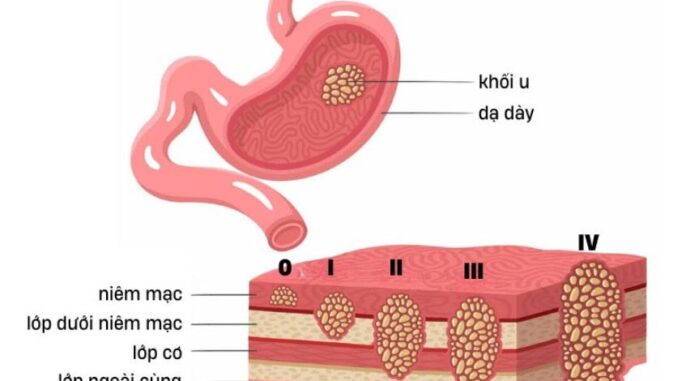 9 triệu chứng UT dạ dày giai đoạn đầu giúp phát hiện sớm bệnh 9 triệu chứng UT dạ dày giai đoạn đầu giúp phát hiện sớm bệnh