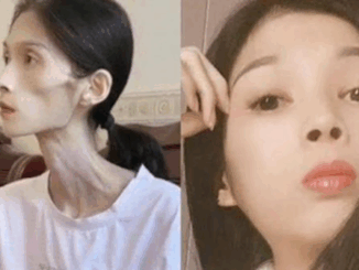 Hình ảnh cô gái 27 tuổi chỉ nặng 17kg vì viêm teo dạ dày gây xót xa: Căn bệnh không thể xem nhẹ, người trẻ cũng cần cảnh giác