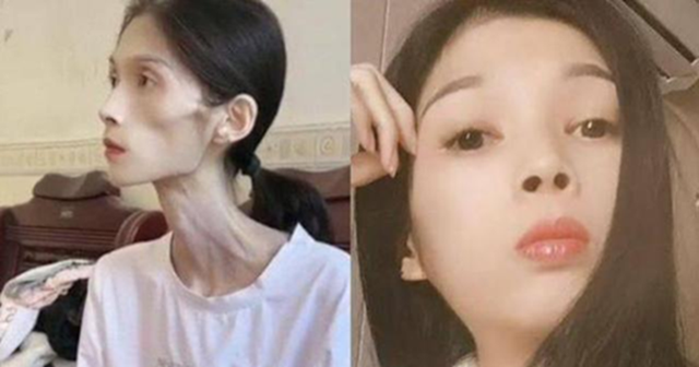 Hình ảnh cô gái 27 tuổi chỉ nặng 17kg vì viêm teo dạ dày gây xót xa: Căn bệnh không thể xem nhẹ, người trẻ cũng cần cảnh giác Hình ảnh cô gái 27 tuổi chỉ nặng 17kg vì viêm teo dạ dày gây xót xa: Căn bệnh không thể xem nhẹ, người trẻ cũng cần cảnh giác